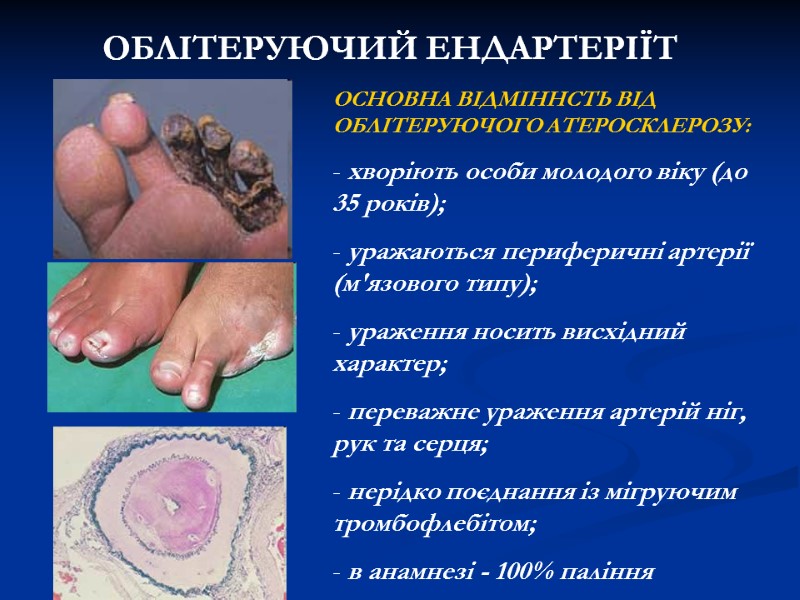 ОБЛІТЕРУЮЧИЙ ЕНДАРТЕРІЇТ ОСНОВНА ВІДМІННСТЬ ВІД ОБЛІТЕРУЮЧОГО АТЕРОСКЛЕРОЗУ: хворіють особи молодого віку ОБЛІТЕРУЮЧИЙ ЕНДАРТЕРІЇТ ОСНОВНА ВІДМІННСТЬ ВІД ОБЛІТЕРУЮЧОГО АТЕРОСКЛЕРОЗУ: хворіють особи молодого віку